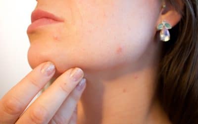 Huiles essentielles : Découvrez le remède miracle naturel contre l’acné